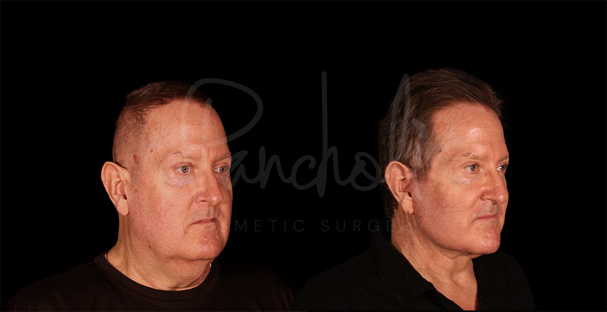 before and after male facelift right angle view case 1176