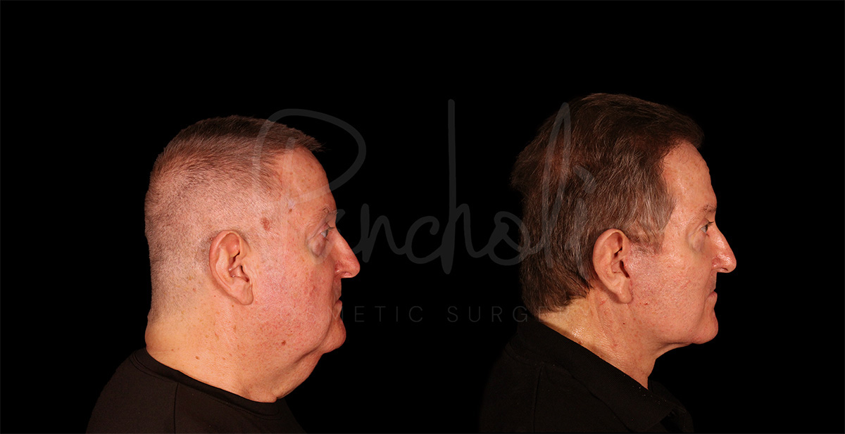 before and after male facelift right side view case 1176