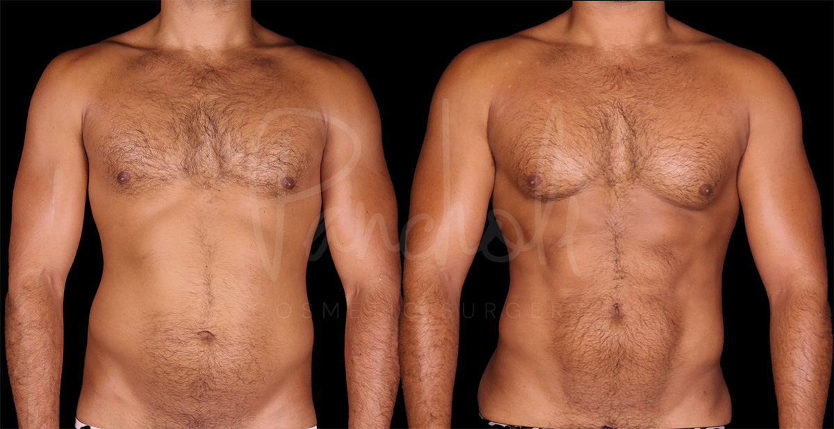 before and after vaser liposuction front view male patient case 1172