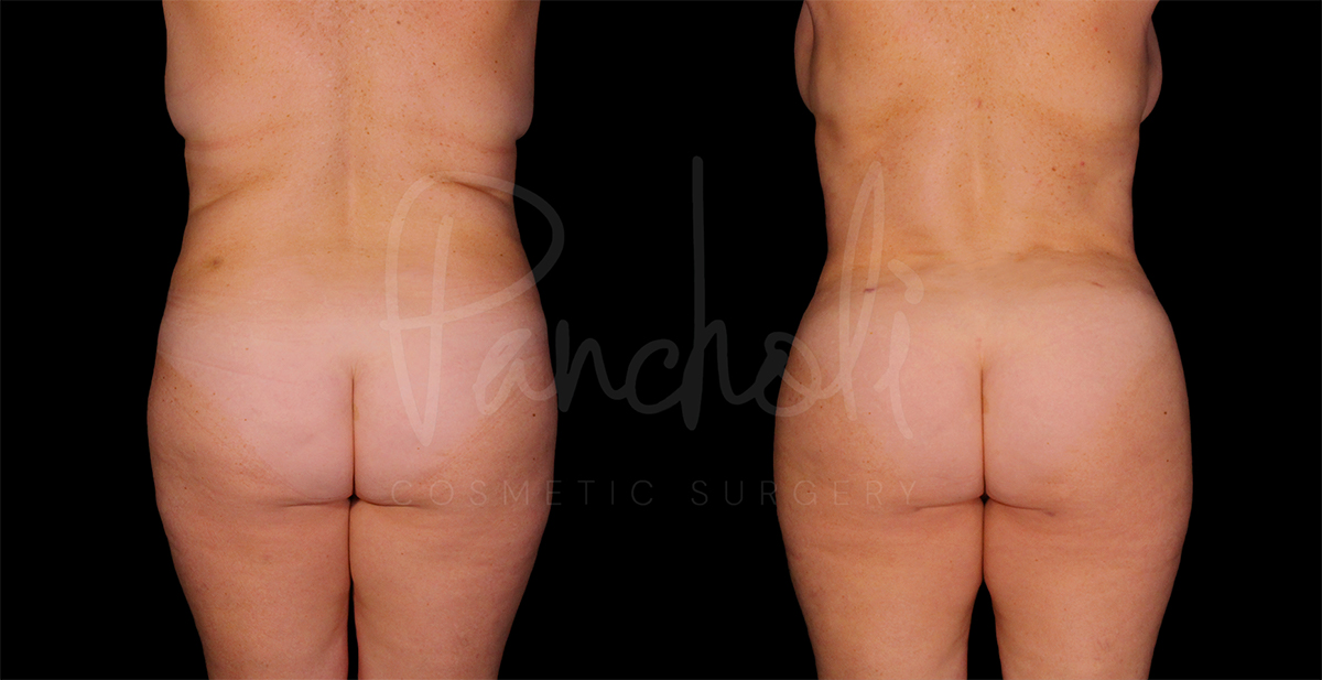 before and after liposuction female patient back view case 1495