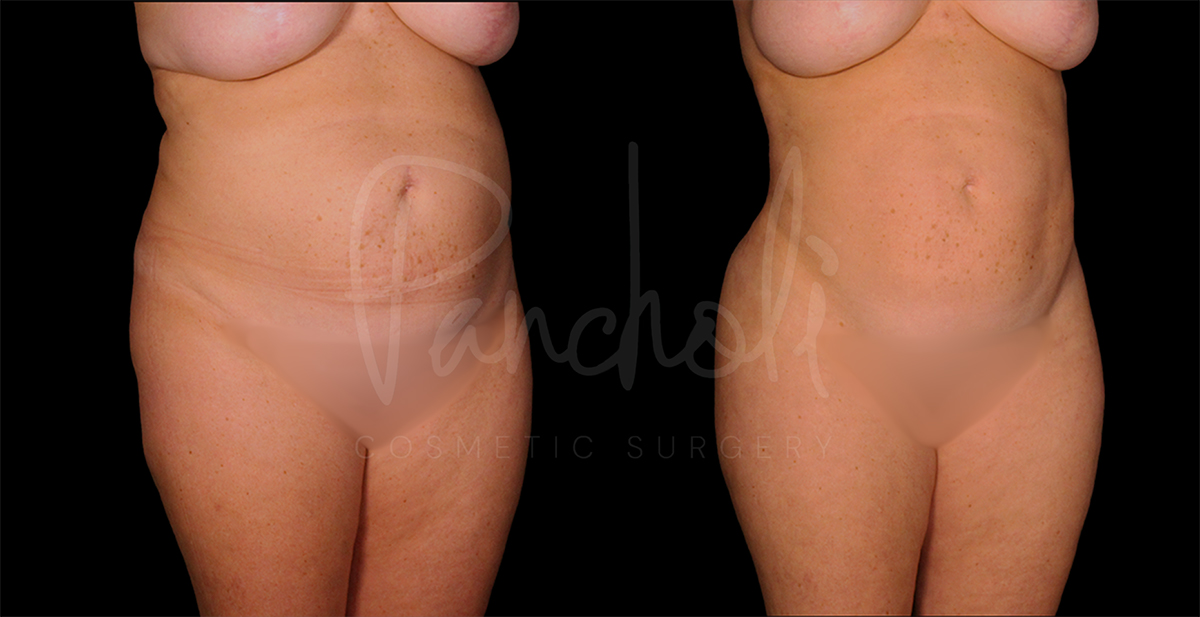 before and after liposuction female patient front angle view case 1495