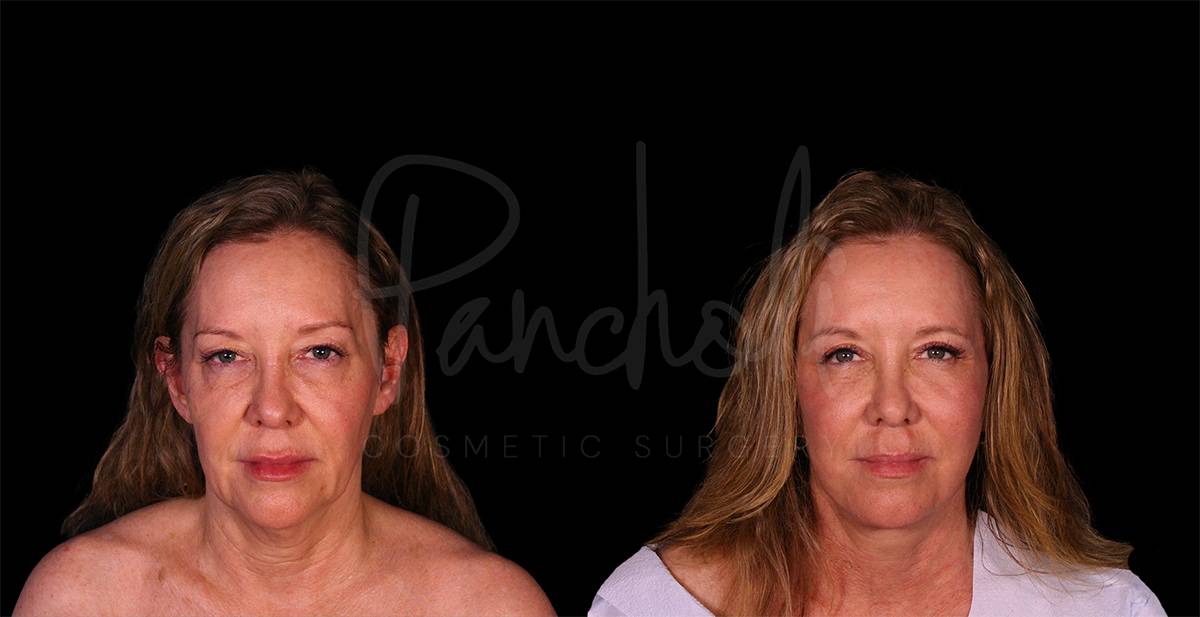 before and after facelift front view female patient case 1880