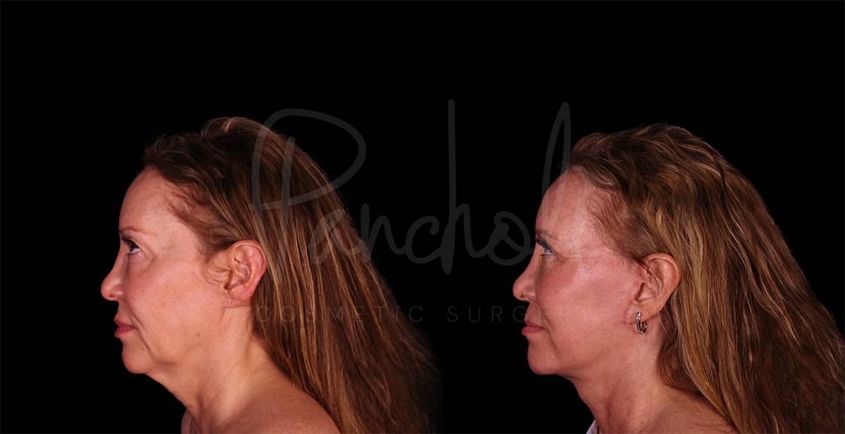before and after facelift side view female patient case 1880