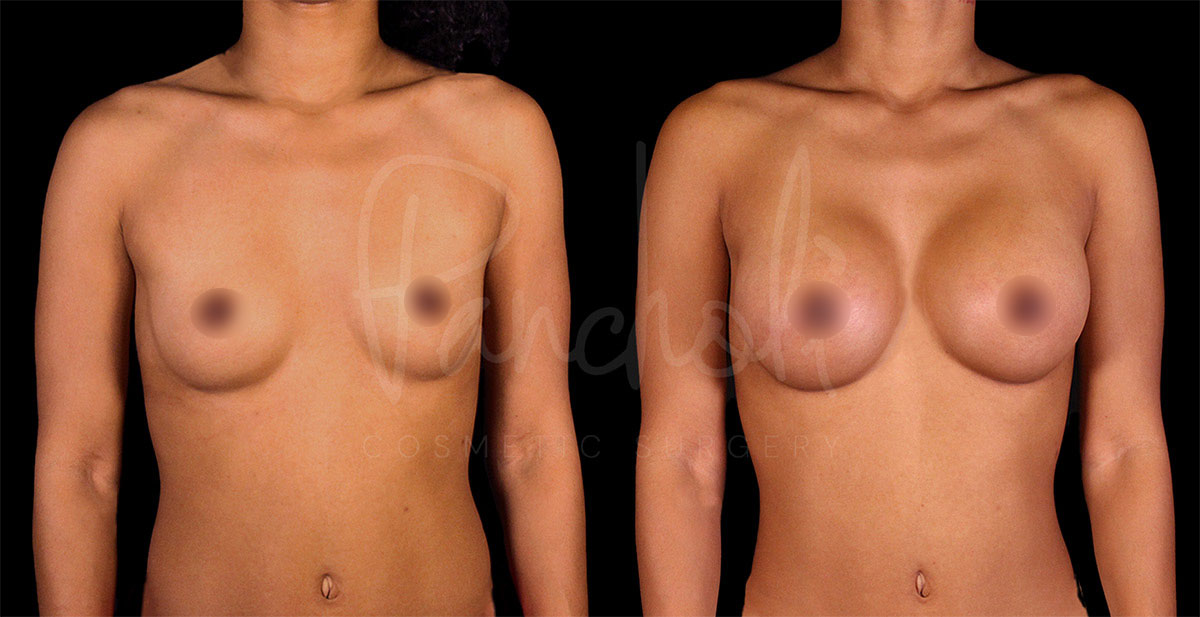 breast-augmentation--1163-1