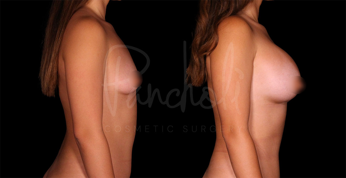 breast-augmentation--1532-1