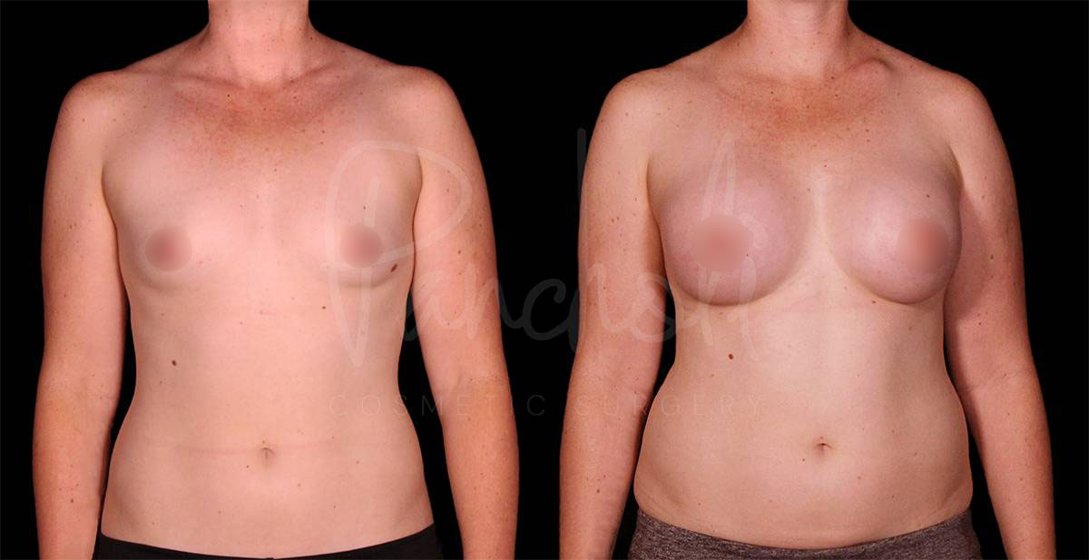 breast-augmentation--8141-1