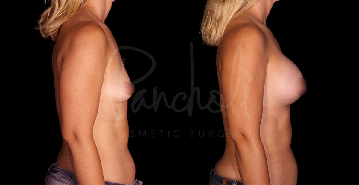 breast-augmentation--8276-1
