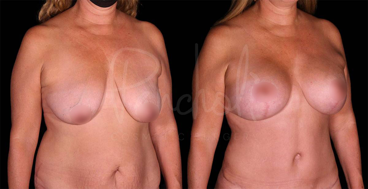 breast-lift--8132-1