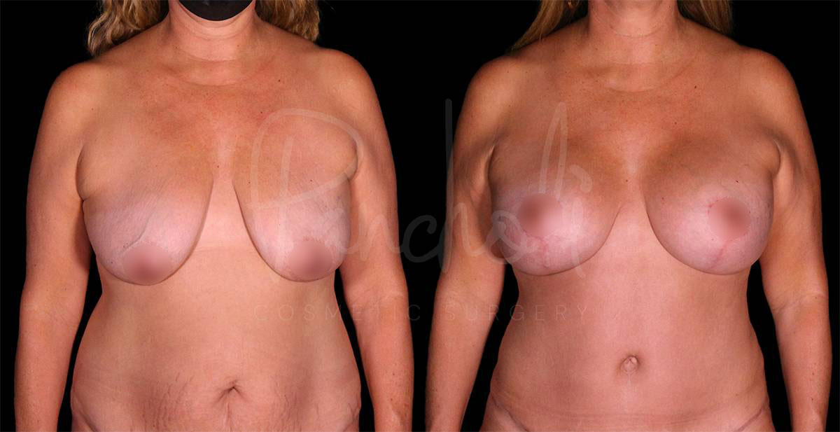 breast-lift-with-implants--8137-1