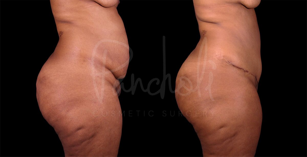 before and after Abdominoplasty with Liposuction side view female patient case 8322